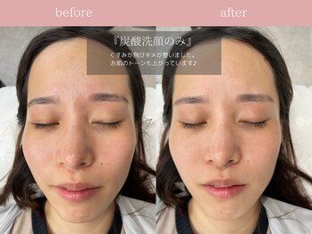 ジョリー(JOLi)/顔脱毛/韓国美肌ワックス