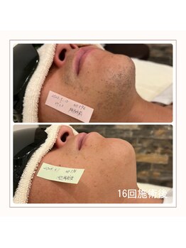 エアリアル 博多店/メンズ　ヒゲ脱毛before→after