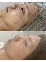 レイ(Lei)/ニキビケアケア大得意◎