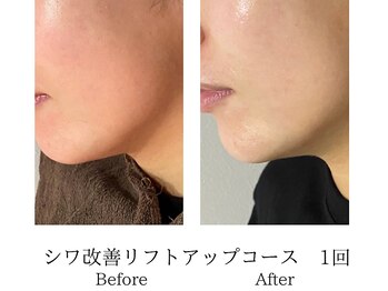 ミーシェ(Meshie)/小顔フェイシャル　ラジオ波