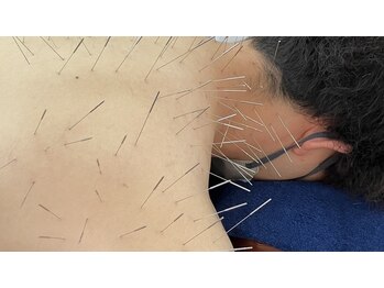 りんどう鍼灸院/ルート鍼 　肩