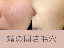 ベアール(beal)/毛穴特化ハーブピーリング4ヶ月