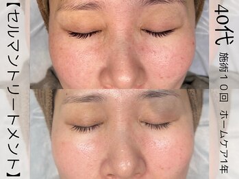 ウイ ネイルアンドビューティー(u'i nail&beauty)/中からふっくらで毛穴消滅!!