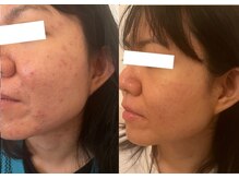 ルポ 那覇(repos)/肌トラブル特化美容鍼100分