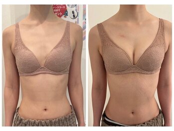 美人バスト 辻堂店/バストアップ ★☆症例写真☆★