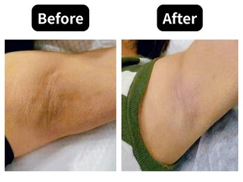 モンロー(MonroE+)/黒ずみ・くすみ・色素ケア