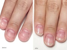 ディグニティ(Dignity)/深爪改善ケア