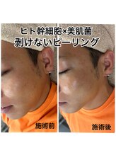 ヴィーナス(Venus)/ヒト幹細胞×美肌菌ピーリング