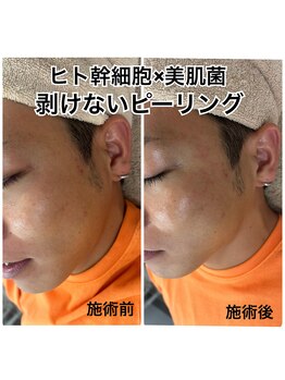 ヴィーナス(Venus)/ヒト幹細胞×美肌菌ピーリング