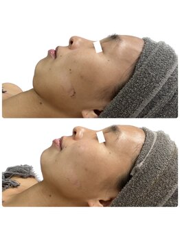 ビビ(Be_bi)/1番人気☆二重顎＋ハーブ