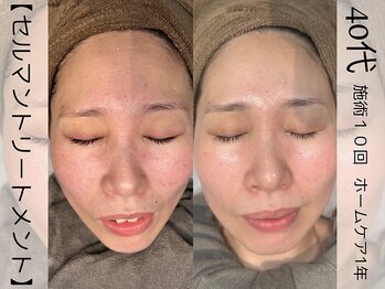 ウイ ネイルアンドビューティー(u'i nail&beauty)/全体的な色むら改善!!