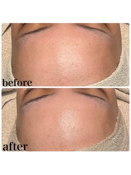 ディオーネ 春日井勝川店(Dione)/顔脱毛+毛穴洗浄