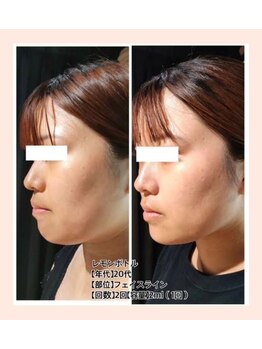 リファイン(REFINE)/顔脂肪撃退！二重アゴ撃退☆