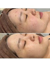 ロザブルー(ROSA BLU)/繰り返さないニキビケアも◎