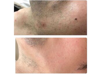 リアンジェ(Lianje)/美肌脱毛　顔