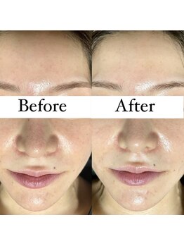 ヴィム(VIM)/ホワイトスノーピール