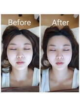 美藤鍼灸院/美容鍼のBefore After