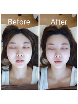 美藤鍼灸院/美容鍼のBefore After