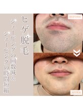 髭ラボ(髭LABO)/ヒゲ脱毛☆シェービングの時短