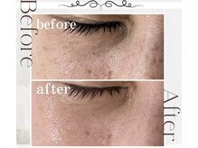 ピュアル 川口(Pual)/【目の周りの小じわ】Pual症例