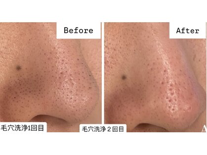 アカヌケ(AKANUKE)の写真