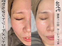 ウイ ネイルアンドビューティー(u'i nail&beauty)/ボリュームのあるお肌に！！