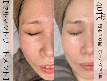 ウイ ネイルアンドビューティー(u'i nail&beauty)/ボリュームのあるお肌に!!