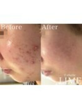 ベル 川越(Belle)/ハーブピーリング｜ニキビケア