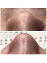 リンカ アオモリ(Rinka aomori)/フェイシャルワックス