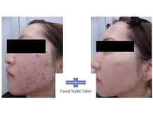 フェイシャルスタイリストサロン 高崎店(Facial Stylist Salon)/ケア例（31）