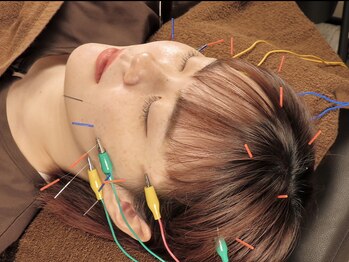 スリープシープ(Sleep Sheep)の写真/美容鍼灸が初めての方にも◎整った施術環境◎お肌のキメを整え美肌UP!ご要望により背部のカッピング施術可!