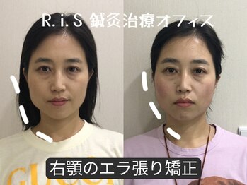 リス(R.i.S)/小顔矯正Before&After