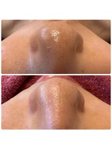 シェリー(cheri)/【オプション】毛穴洗浄