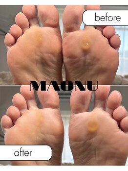 マオヌー(MAONU)/韓国式足裏角質ケア　症例写真