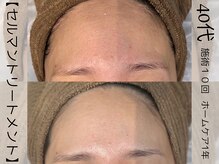 ウイ ネイルアンドビューティー(u'i nail&beauty)/ふっくらお肌で小皺もサヨナラ☆