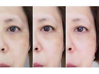 リープラス 赤坂(Re-plus)/ダーマ鍼《目元こじわ改善》