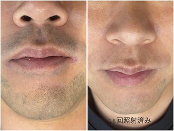 レイズ(RAISE)/メンズ人気！ヒゲ脱毛