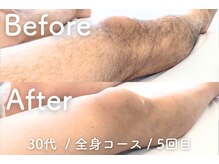 ユング 渋谷店(YUNG)/【足脱毛】大人の足だしデビュー