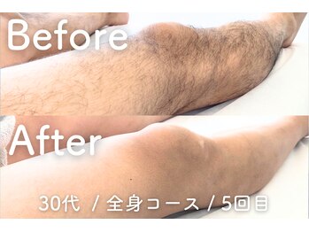 ユング 渋谷店(YUNG)/【足脱毛】大人の足だしデビュー