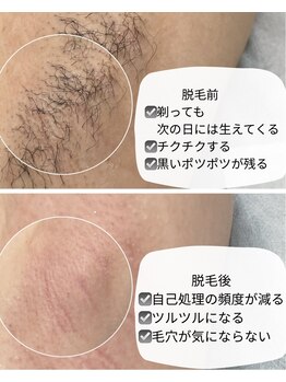 サロンドベルム(Salon de BELME)/ダブル脱毛:before/after