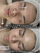 エメ(Aimer)/肌質改善フェイシャル