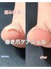 【Foot】痛み軽減◎巻き爪専用ケア1本¥6,000(通常¥7,000)