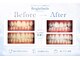 ブライトスマイル 静岡店(Bright Smile)の写真/【U24学割】1500円で歯を白くして、人前で心からの笑顔を！輝くイベントの準備を◎