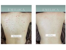 エミルカ 岡山店(EMILUCA)/お客様の施術事例8回目施術後