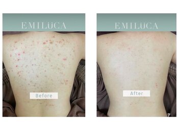 エミルカ 岡山店(EMILUCA)/お客様の施術事例8回目施術後