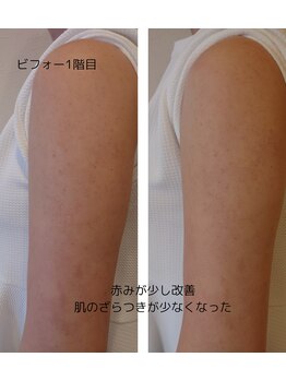 カモン(KAMON)/【肌育革命】美肌ピーリング体験