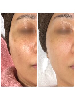 シーラックス(Sealax)/ヒト臍帯血幹細胞培養液♪