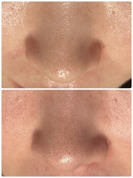 エイチビューティーラボ(h Beauty labo)/毛穴洗浄