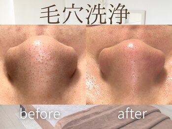 ラグレ(LUXRE)/ハイドロ毛穴洗浄