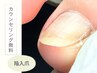 【カウンセリング無料!】深爪・陥入爪ケア1箇所¥5,500~
